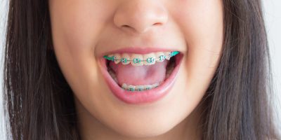 Icon style image for blog: The Rise of Coloured Braces as a Fashion Statement