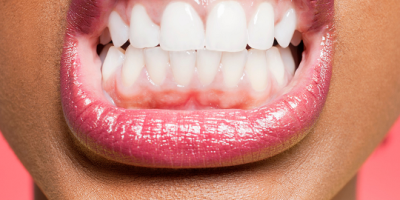 Icon style image for blog: How Stress Affects Oral Health