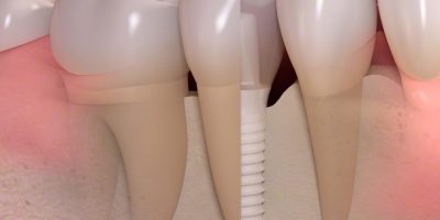 Icon style image for blog: Ten Reasons Dental Implants Are The Best Option