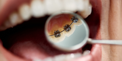 Icon style image for blog: The Invisible Advantage: Precision and Discretion in Lingual Orthodontics